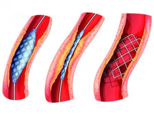 القسطرة القلبية والشبكة 