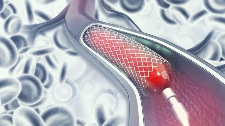 القسطرة القلبية العلاجية