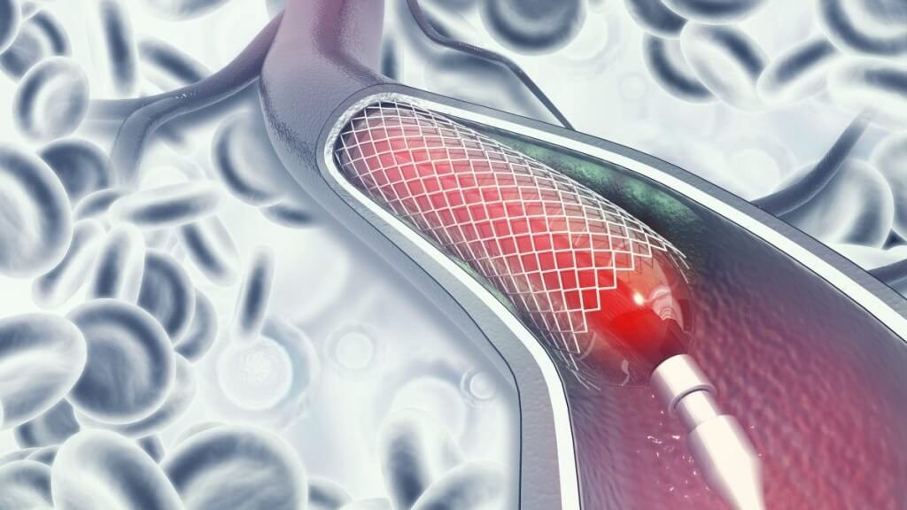القسطرة القلبية العلاجية