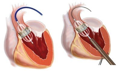 القسطرة القلبية وأضرارها