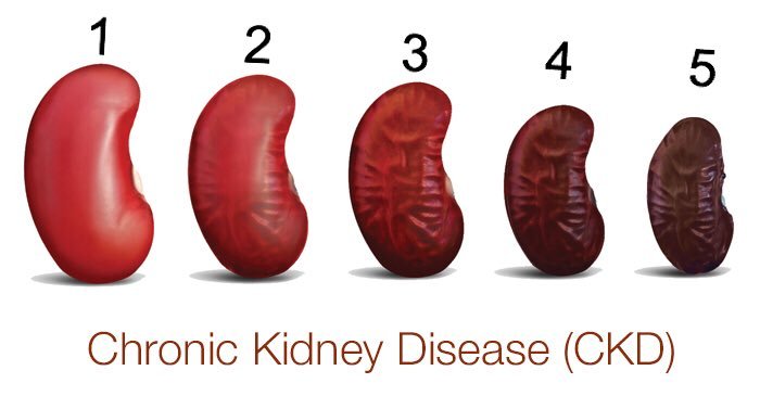 علاج لضمور الكلى