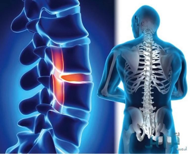 دور الأشعة التداخلية لعلاج مشاكل العمود الفقري