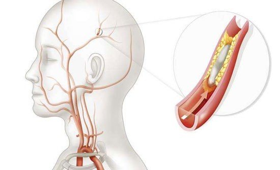  الكشف عن الجلطة الدماغية