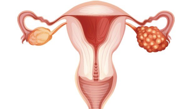 الأشعة التداخلية لعلاج الأورام الليفية