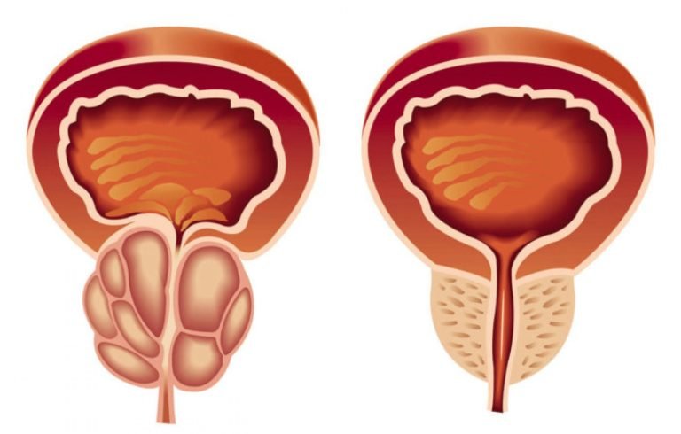 تكلفة عملية قسطرة البروستاتا