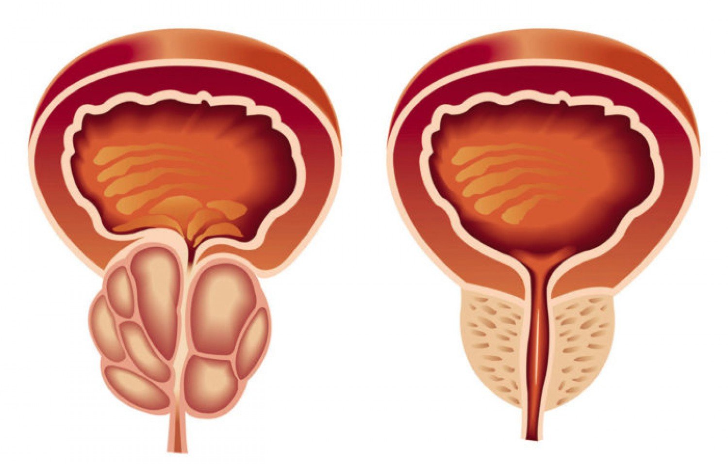 تكلفة عملية قسطرة البروستاتا