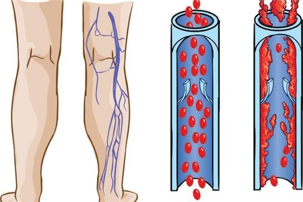 ما هو علاج الاوعية الدموية