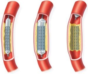 أسعار القسطرة القلبية والشبكة