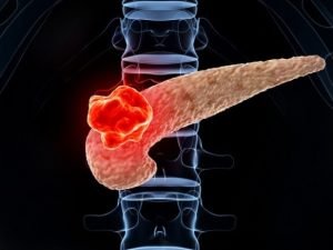 نسبة الشفاء من سرطان البنكرياس