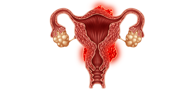 اعراض اورام الرحم