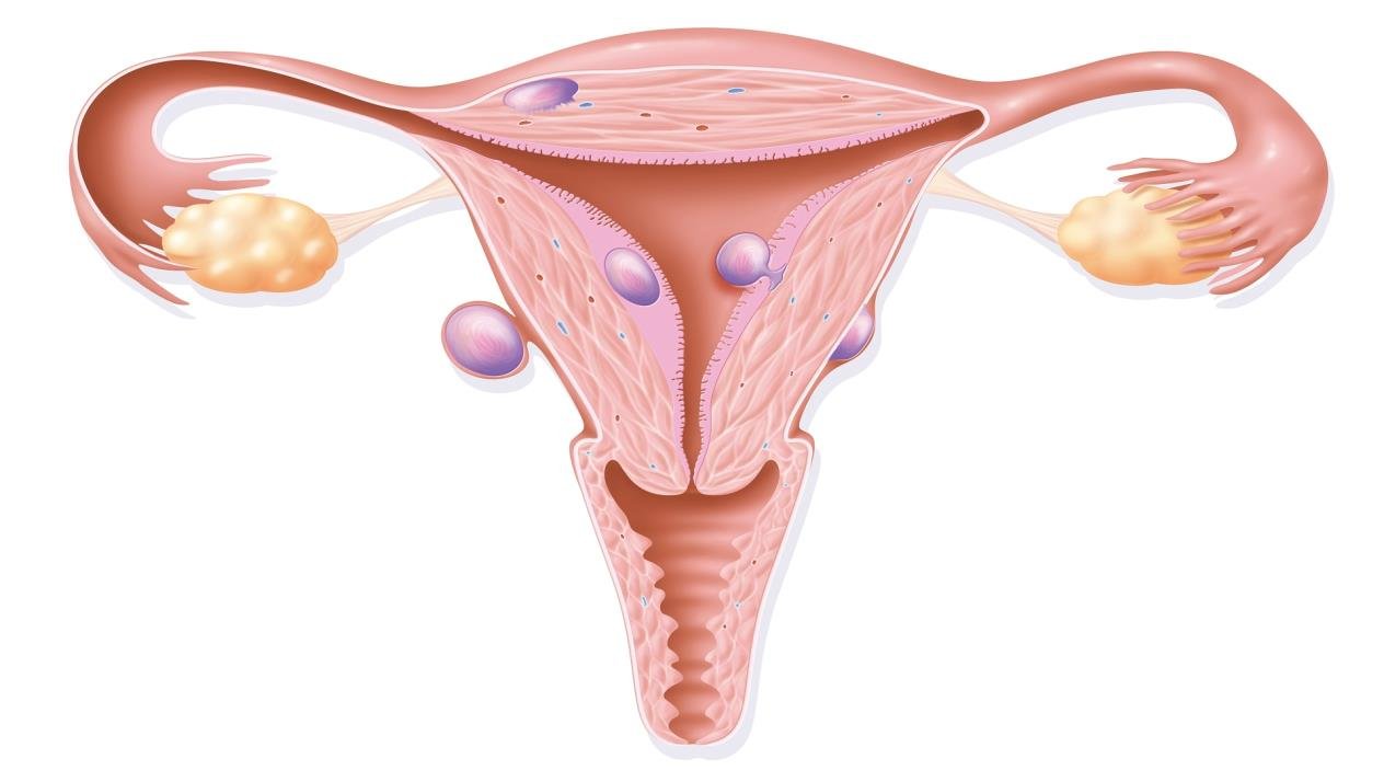 هل يتحول الورم الليفي في الرحم إلى سرطان