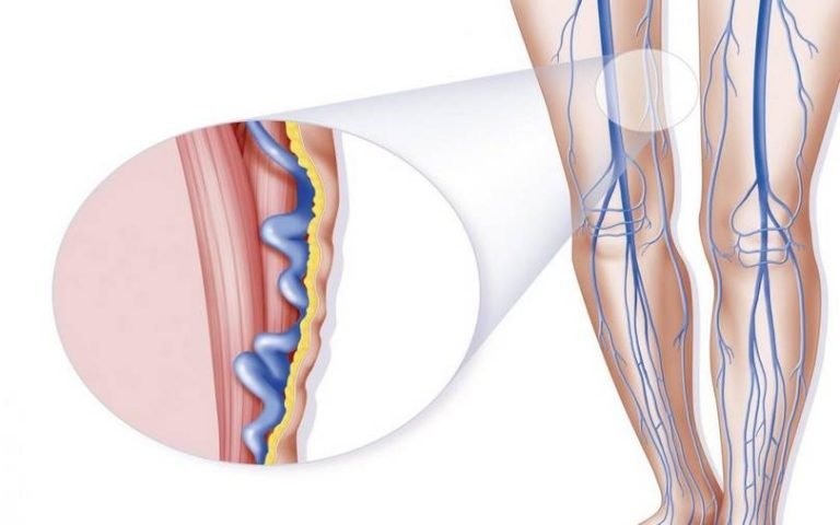 ًعلاج الدوالي نهائيا