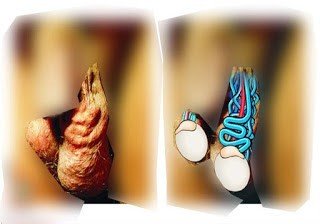 أعراض دوالي الخصية