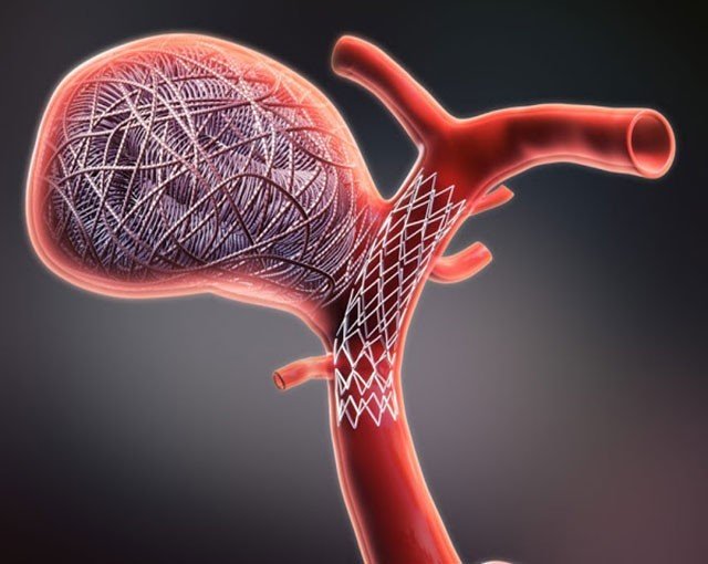 أسعار قسطرة المخ