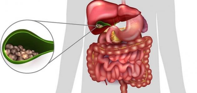 التعايش مع حصوات المرارة