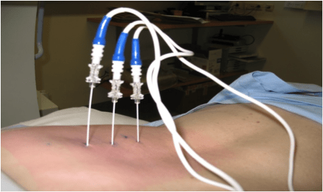 سعر ابرة التردد الحرارى