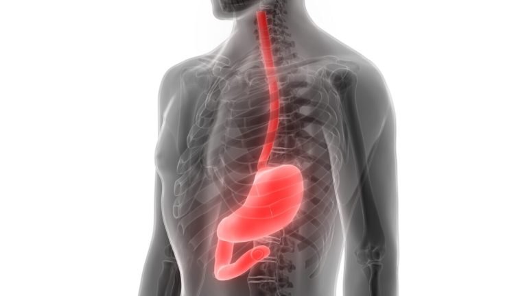 دوالي المعدة