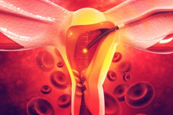 هل الورم الليفي ينزل مع الدورة