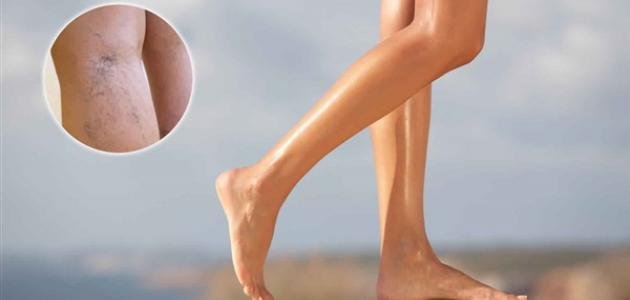 أفضل حبوب لعلاج الدوالي