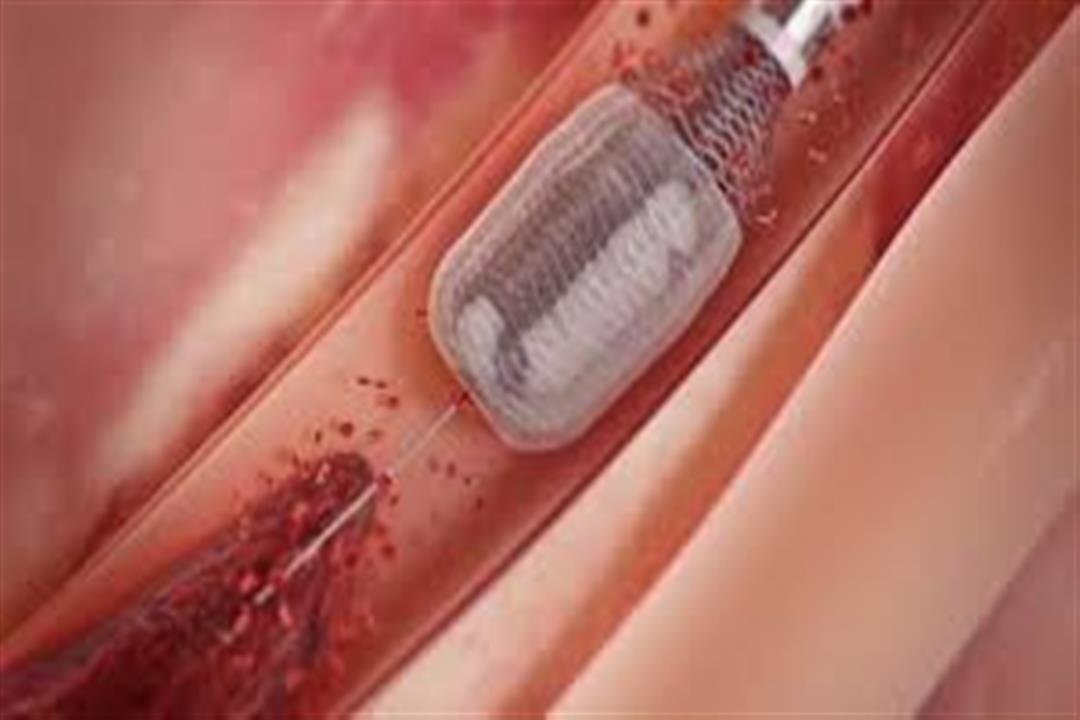 انسداد القناة المرارية