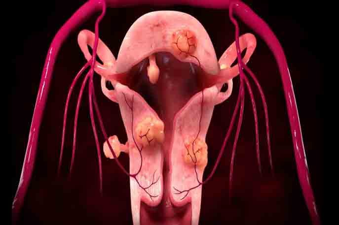 أعراض الأورام الليفية