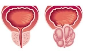أعراض تضخم البروستاتا الخبيث