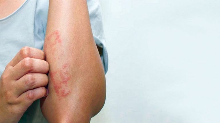 أعراض سرطان الدم