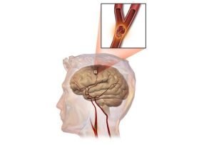 أعراض السكتة الدماغية