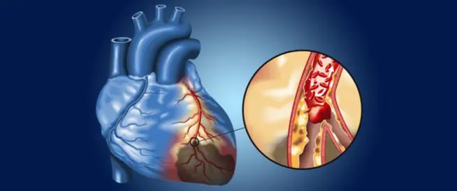 اعراض انسداد الاوعية الدموية
