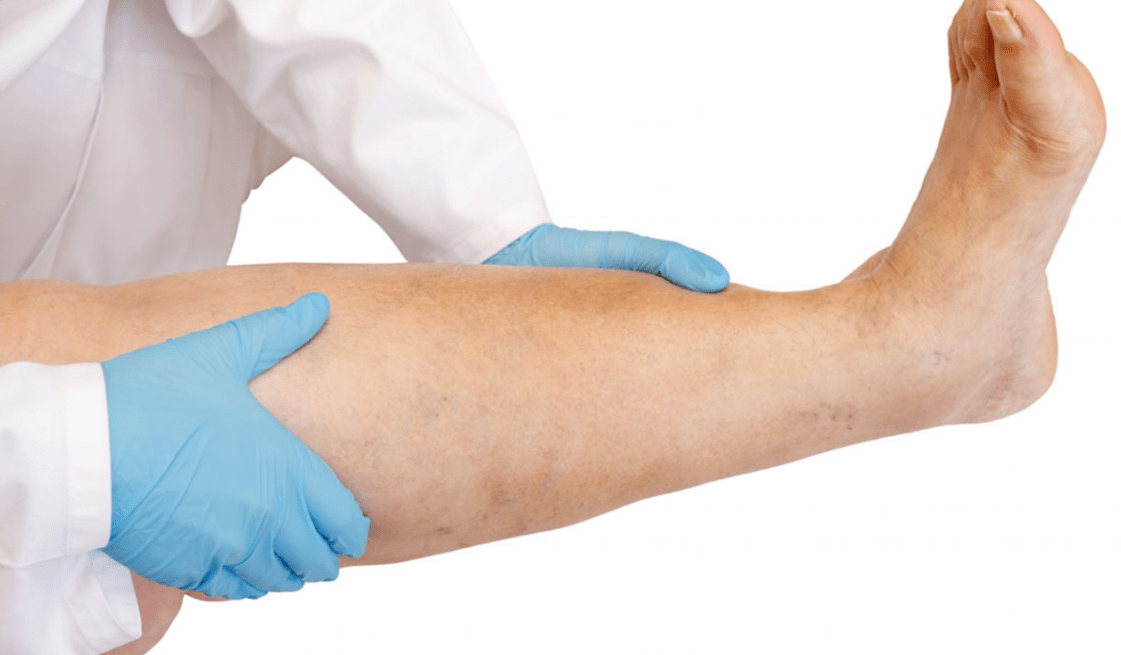 علاج الاوعية الدموية