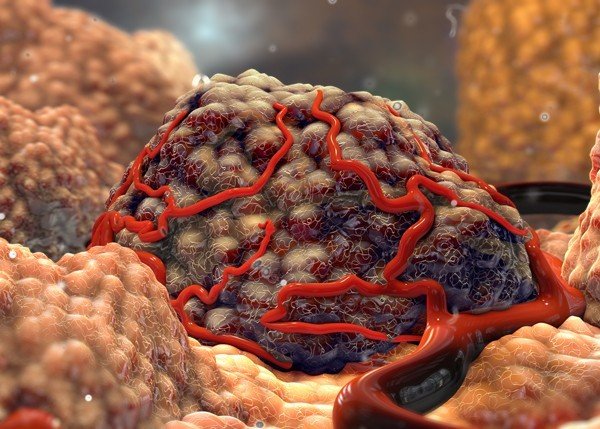 علاج الأورام