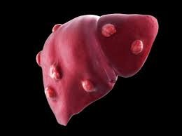 أورام الكبد وعلاجها