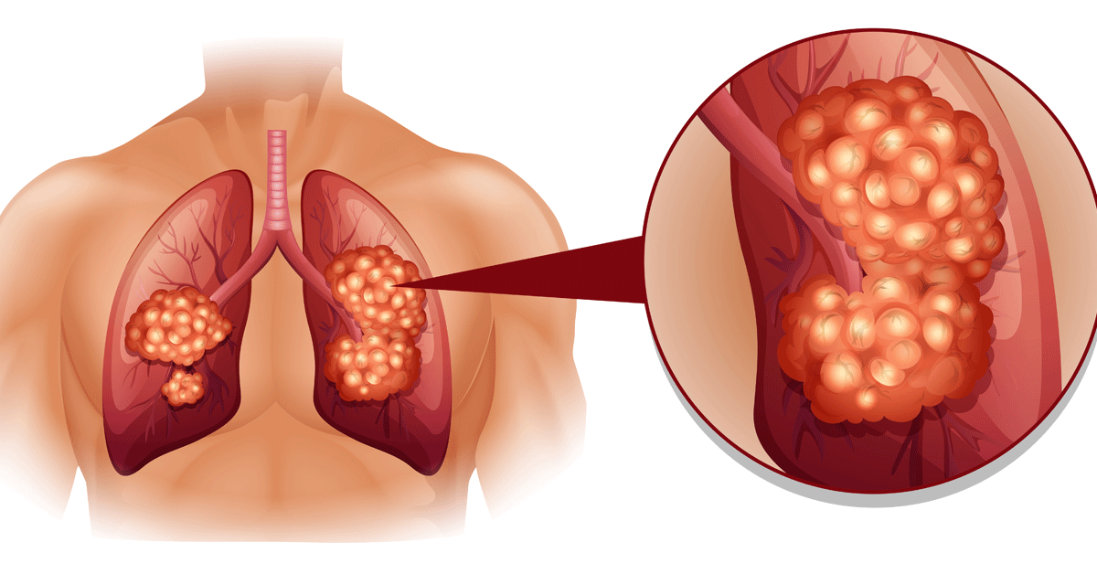 علاج أورام الرئة