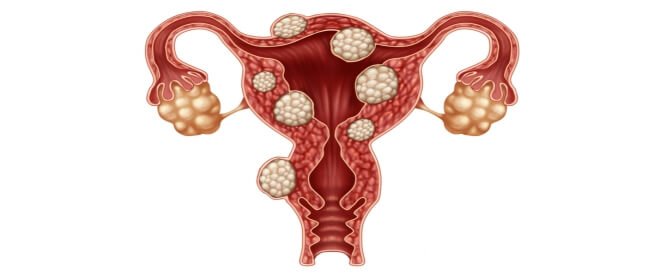 أنواع الأورام و علاجها