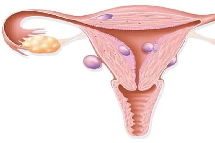 الأورام الليفية في الرحم