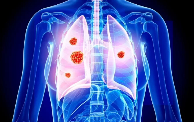 أورام الرئة وعلاجها