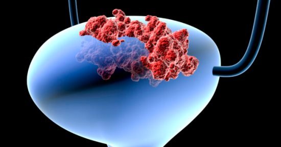 علاج أورام المثانة