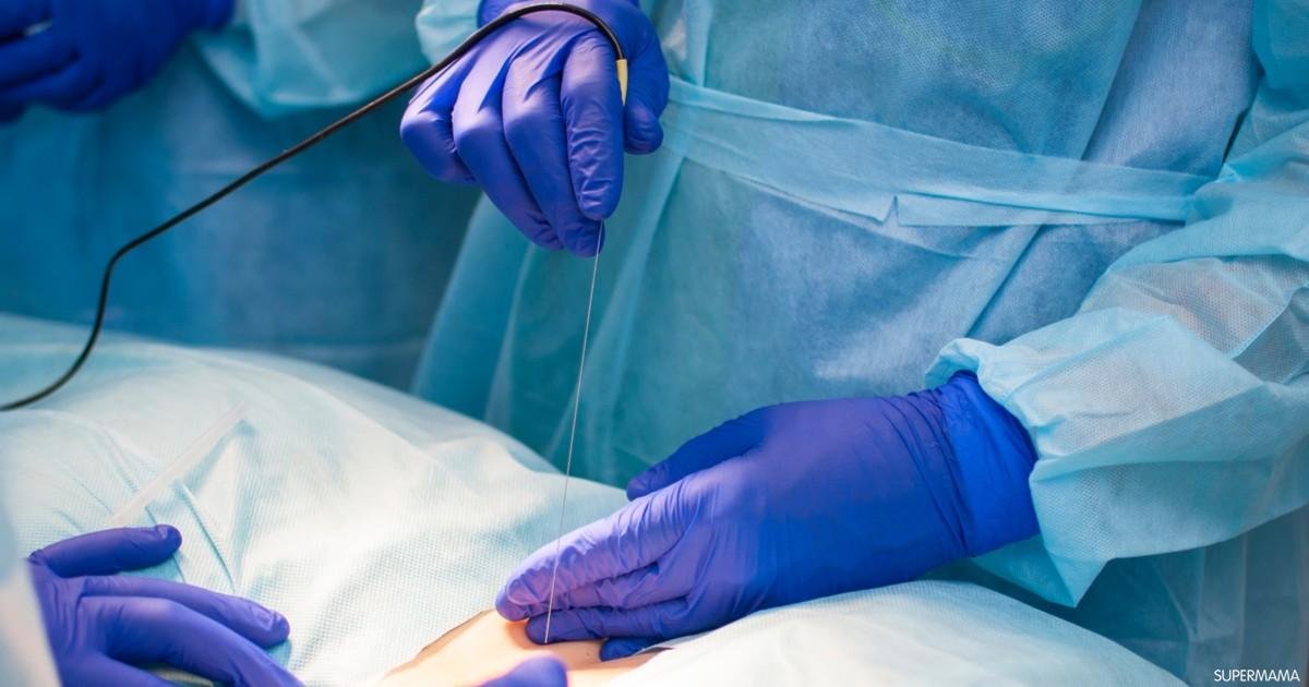 بعد عملية قسطرة القلب