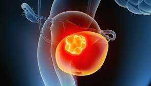 علاج أورام المثانة