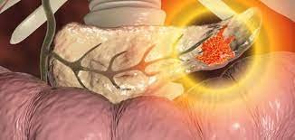 علاج أورام البنكرياس