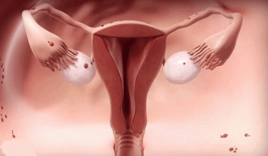 أورام المهبل وعلاجها 