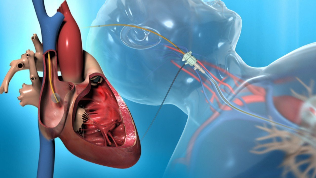 القسطرة القلبية لكبار السن