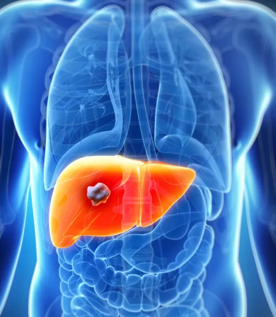 طرق علاج اورام الكبد الخبيثة
