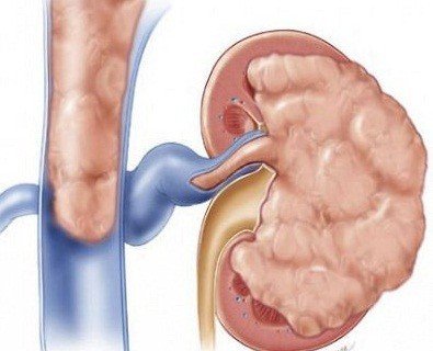 علاج اورام الكلي