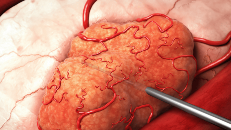 علاج الاورام الحميدة