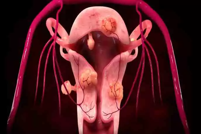 طرق علاج الاورام الليفية