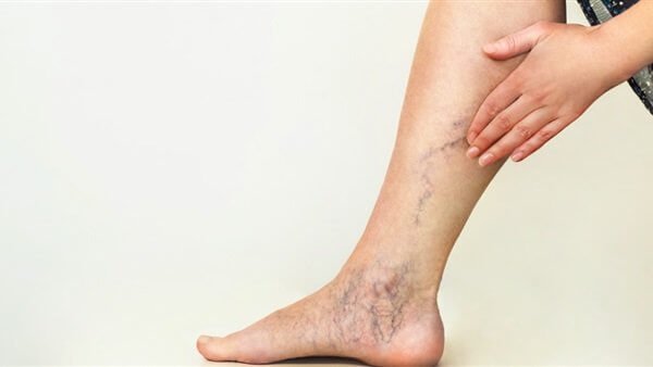 ما سبب ضعف الاوعية الدموية