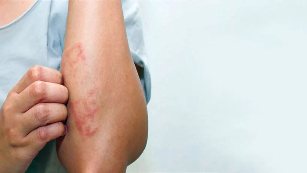 ماهي اعراض سرطان الدم الليمفاوي