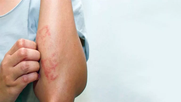 ماهي اعراض سرطان الدم الليمفاوي