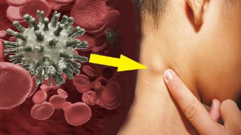 أعراض سرطان الدم الليمفاوي المزمن